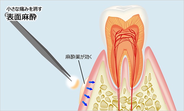 表面麻酔で歯茎に生じる痛みを軽減できます