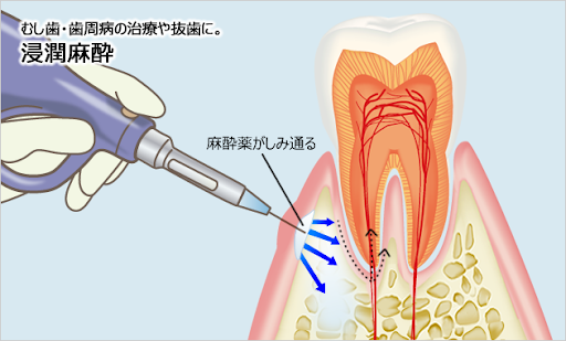 電動麻酔器の使用で麻酔時の痛みを緩和できます