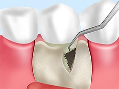 歯周外科治療【フラップ手術】