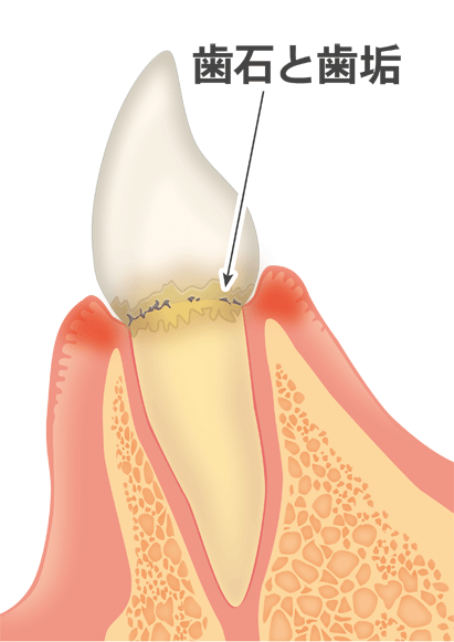 軽度歯周病（歯肉炎／軽度歯周炎）